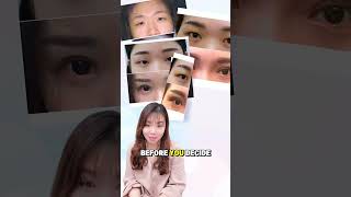 Double Eyelid Stitching & Surgery Price in Malaysia | How to Choose the Right Clinic