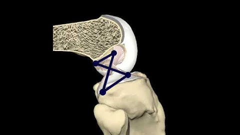Superimposed four-bar linkage to follow joint flexion there are no fixed link lengths