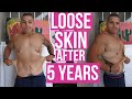 I Have Lived With Loose Skin for 5 Years (My Real Thoughts)