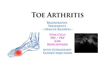 Toe Arthritis (MTP): Regenerative Stem Cells with Ultrasound-Guided Minimally-Invasive Injections