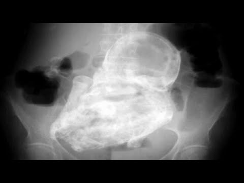 Akutwa Na Mtoto Jiwe Kwa Zaidi Ya Miaka 40 Baada Ya Kulalamika Maumivu Ya Tumbo 