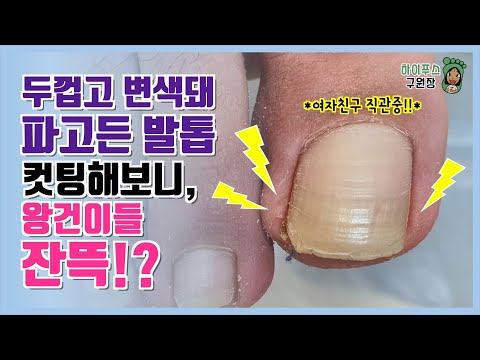 두껍게 파고든 발톱, 긁어내보니 왕건이들이 잔뜩! 여자친구 손에 이끌려 레푸스 송도점에 방문해주셨어요