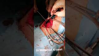 استئصال الغدة الدرقية الكامل zukerkandle tubercle