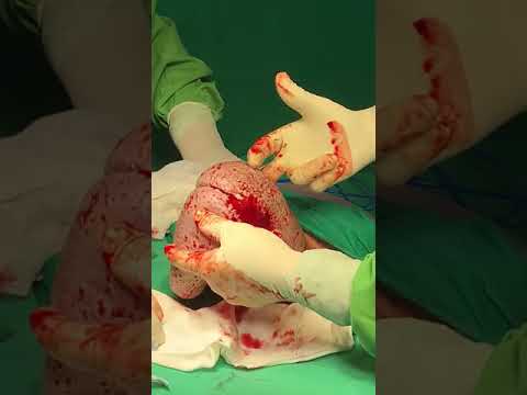 Cesariana por apresentação pélvica/Cesarean section for breech presentation​