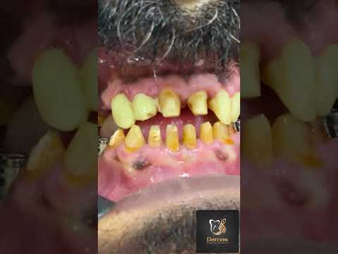 الكيكات زيركنيوم فى الشيخ زايد أشهر عيادة واستشاريه تركيبات وزراعة الاسنان 01096101006
