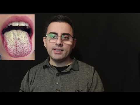 სოკოვანი ინფექცია - პირის, გენიტალიების, ფრჩხილების.  კანდიდიაზი, ონიქომიკოზი