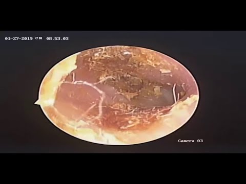Video Bóc lấy mảng ráy tai quá đã (Part 6) - youtube
