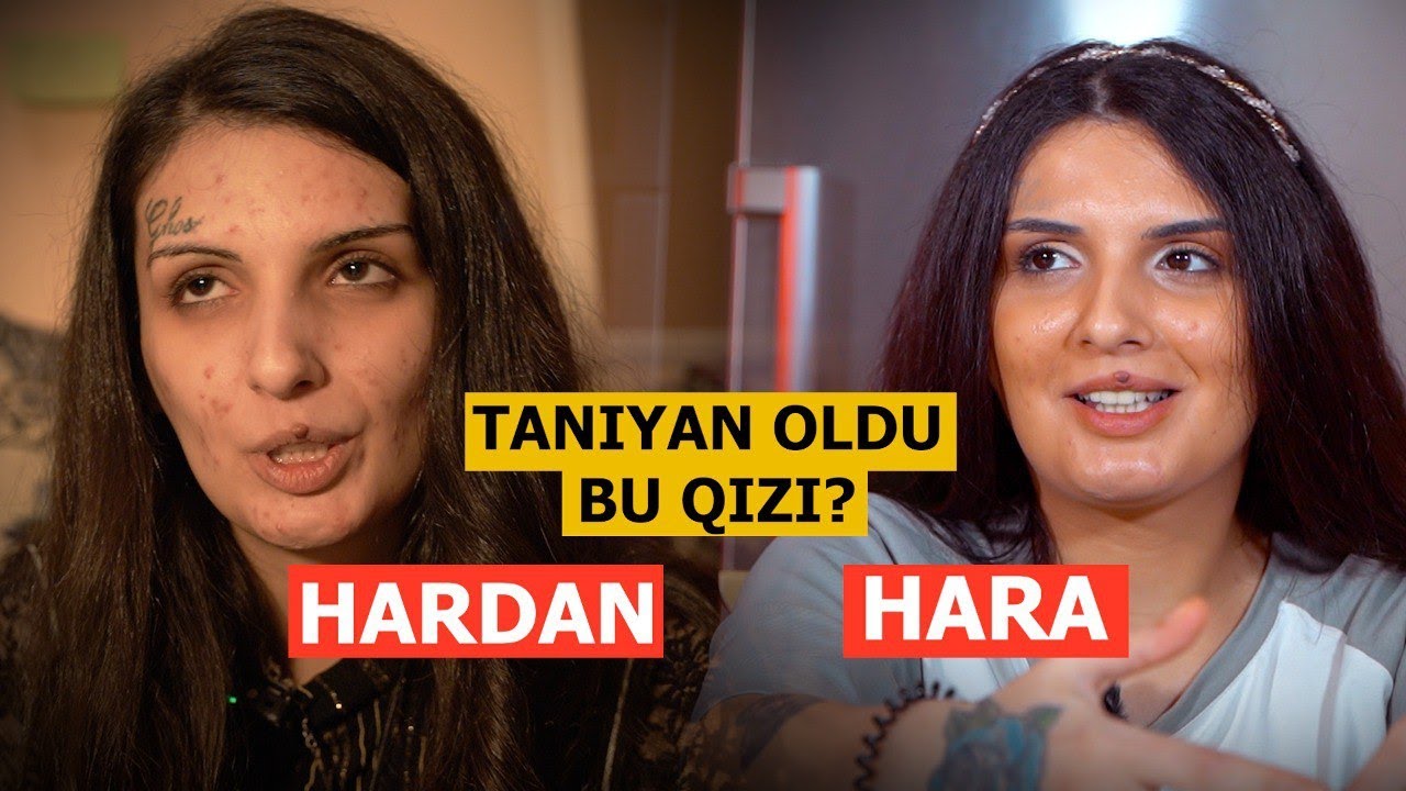 İnsanları mutlu edən qız LALƏ 4 aya belə dəyişdi