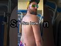Mistakes Were Made Comedy Funny Laugh Husband Sunburn 