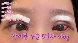 [vlog] *쌍수 브이로그4* 쌍꺼풀 수술 5일차 feat.결막부종