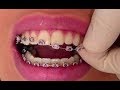 Life After Orthodontic Braces By Dr Mike Mew