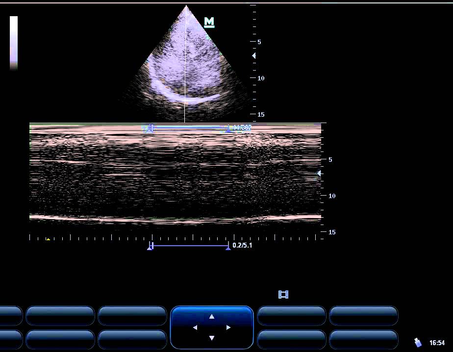 diaphragmatic weakness by all views YouTube