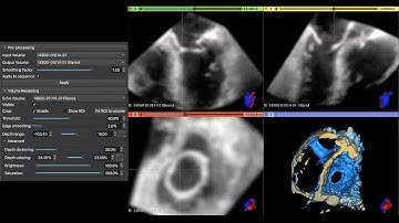 SlicerHeart: Echo Volume Rendering Module in 3D Slicer