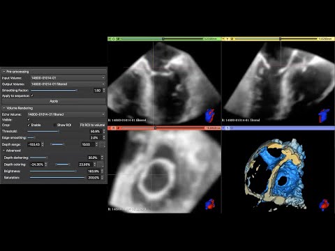 SlicerHeart: Echo Volume Rendering Module in 3D Slicer