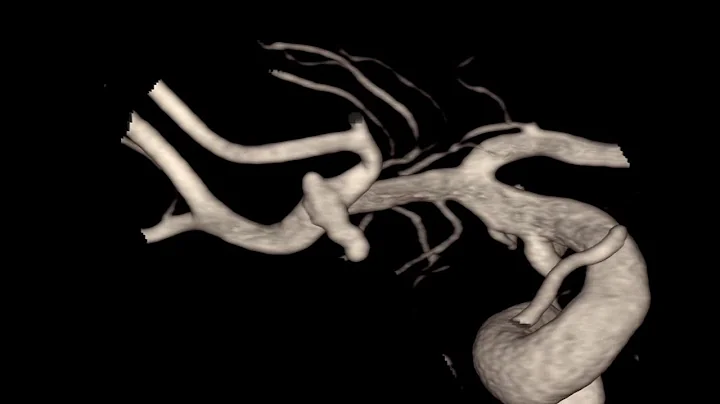 Aneurysm MCA. Balloon-assisted embolization. Coil movement