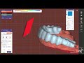 #exocad splint preparation