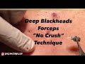 Blackhead revenge part 1 of 3 part 2  will be published 61519 subscribe to see it