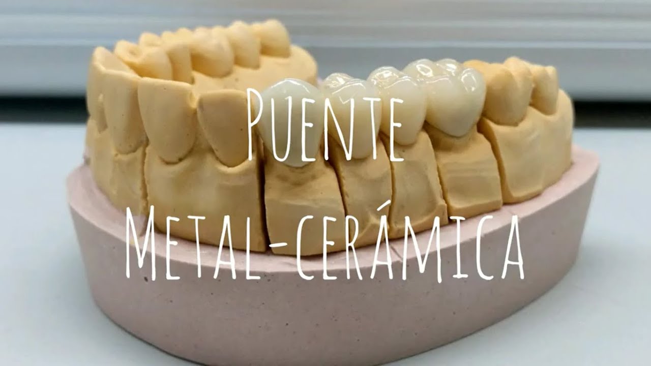 Puente metal-cerámica