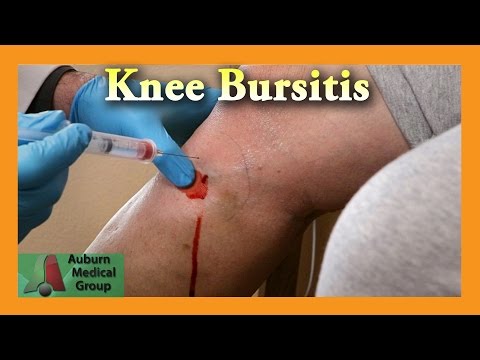 Pes Anserine Bursitis Lutut Injection | Auburn Medical Group