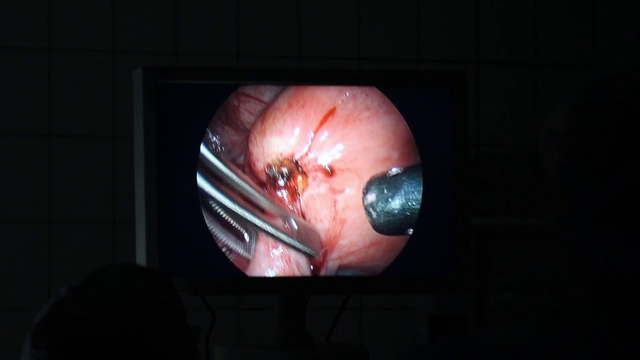 Fibroids és paraziták kezelése