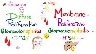 Diffuse Proliferative Glomerulonephritis vs Membranoproliferative Glomerulonephritis | DPGN vs MPGN