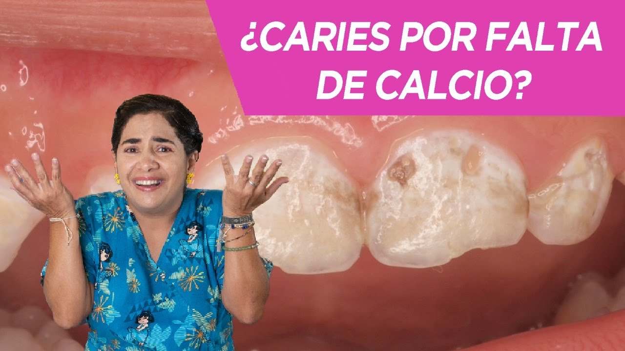 ¿Caries por falta de calcio en niños?
