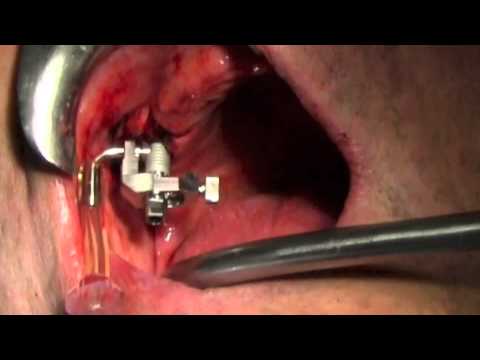 iraise-sinus-lift-procedure,-dr-tallarico-m,-rome,-italy,-sep-2012