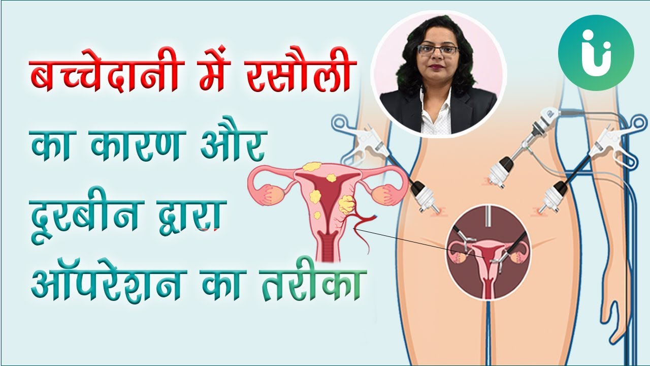 बच्चेदानी में रसौली होने का कारण, इलाज और दूरबीन द्वारा ऑपरेशन का तरीका by Dr. Pulkit Nandwani