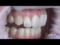 Beautiful veneers delivered under rubber dam isolation