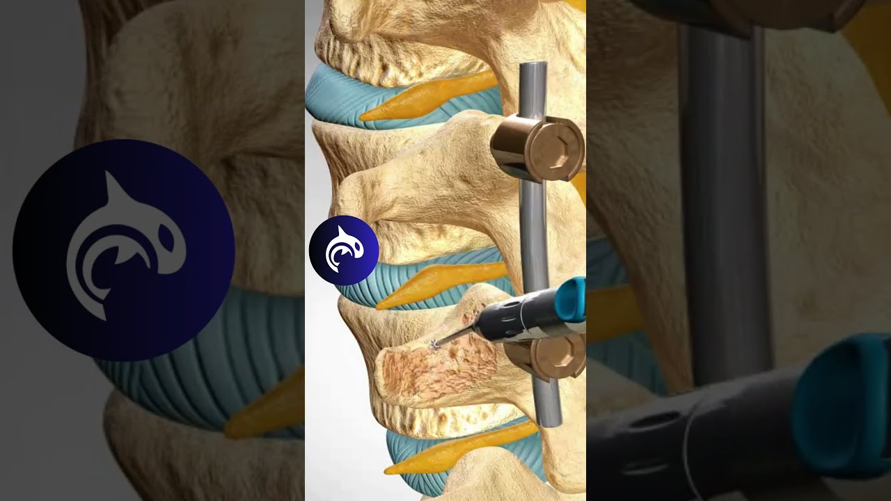 See How A Lumbar Fusion Of The Spine Works In 3D Animation Backpain Stem