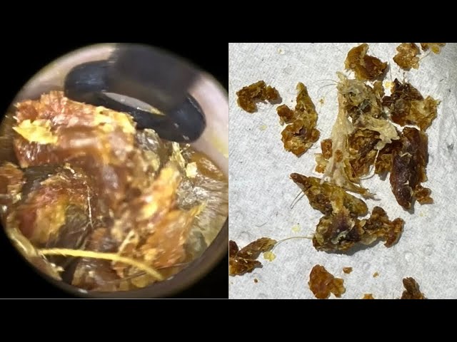 140 - Fully Blocked Dead Skin Extracted & Peeled from Both Ears using WAXscope®️ class=