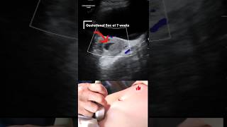 Vaginal Bleeding at 7weeks Ultrasound Reveals Surprising Truthshorts pregnancy ultrasound