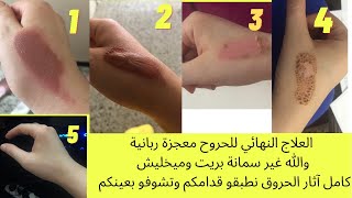 علاج الحروق الطبيعي طريقة التحضير في صندوق الوصف سعرها20ألف والناس تخسر في دراهم كبار أنشرها تأجر