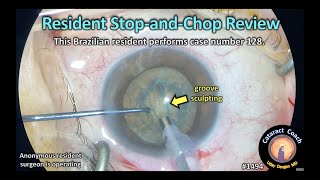 CataractCoach 1494: resident stop and chop cataract surgery