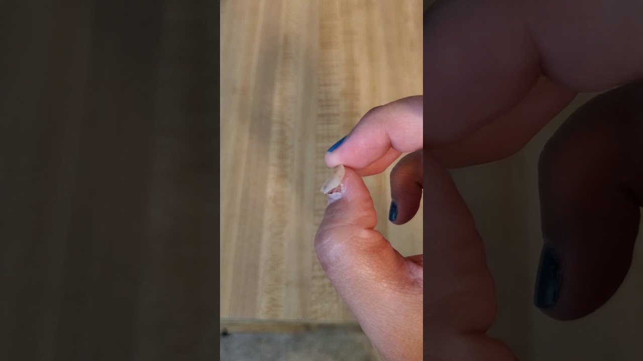 Thumb nail loose - YouTube