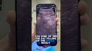 Ultrasound Guided Bbl Brazilian Lift