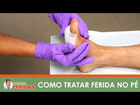 Vídeo: 3 maneiras de tratar uma ferida no pé