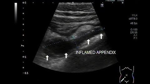 Ultrasound Video showing Inflamed Appendix.