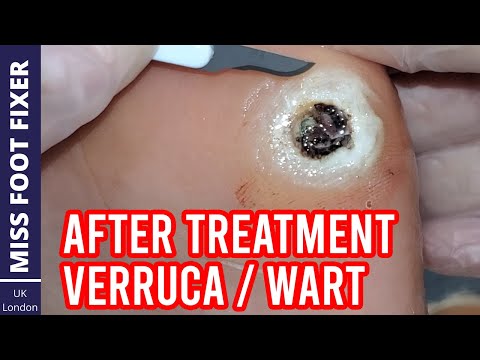 Видео: Хүүхэдээс хэрхэн Warts арилгах вэ?