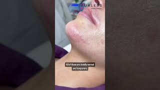 Furless Permanent Hair Removal via Electrolysis | Temporary Side Effects Are Normal