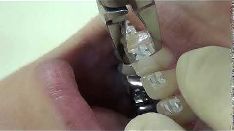 tháo mắc cài sứ tự buộc clippy c