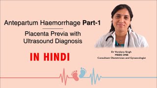 Episode-16 Antepartum Haemorrhage Part-1 Placenta Previa with Ultrasound | In Hindi | Dr Vandana
