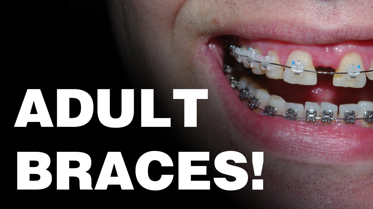 Getting adult braces in British Columbia YouTube