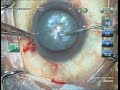 Crhexis technique capsulorhexis in intumescent mature cataract dr manas nath