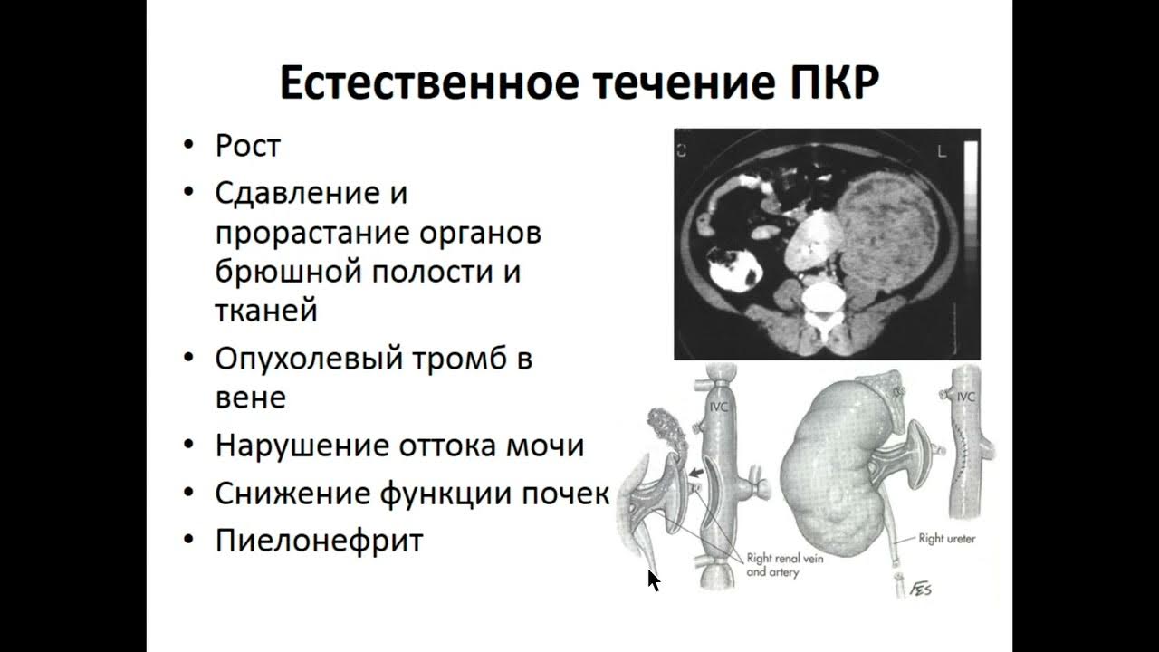 Образование лоханки почки кт. Ангиомиолипома почки кт. Рак почки рекомендации