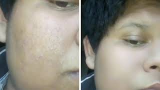Snapseed-How To Clear Pimple From Photos screenshot 5