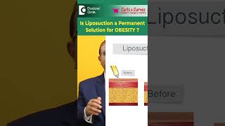 Is Liposuction a Permanent Solution for Obesity? | Dr. Girish A.C. | Curls &amp; Curves