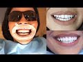 HOW I FIXED MY TEETH WITHOUT VENEERS! (part 2)