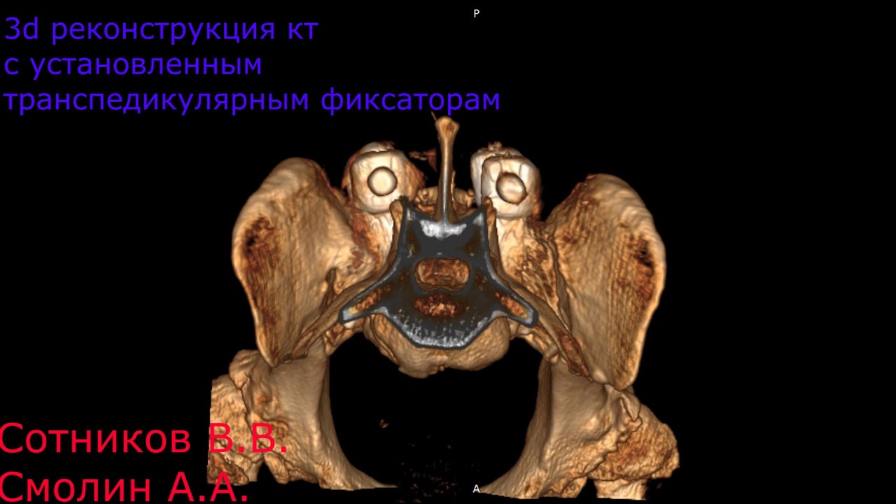 Люмбосакральный стеноз