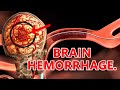 Brain hemorrhage  🧠🩸